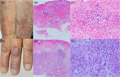 A case of erythema elevatum diutinum associated with immunoglobulin A vasculitis